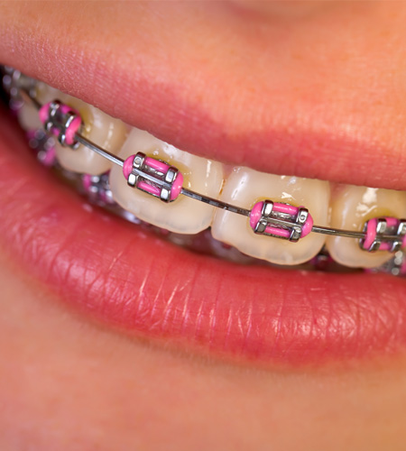 boitier regulier orthodontie