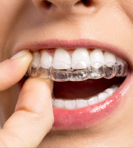 Invisalign orthodontie